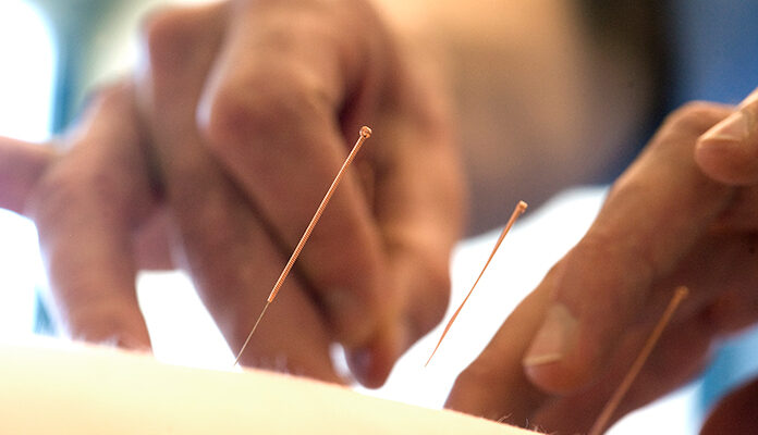 Acupunctuur