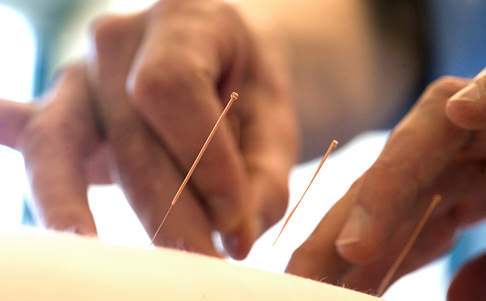 Acupunctuur